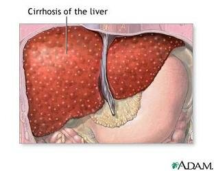 symptoms-liver-disease-health_liver-cirrhosis